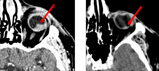 Zeit nach Cyberknife Tumorbehandlung